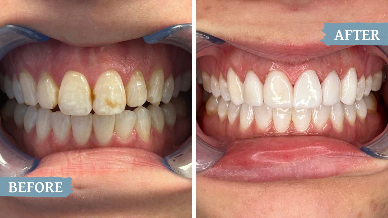 teeth before and after treatment
