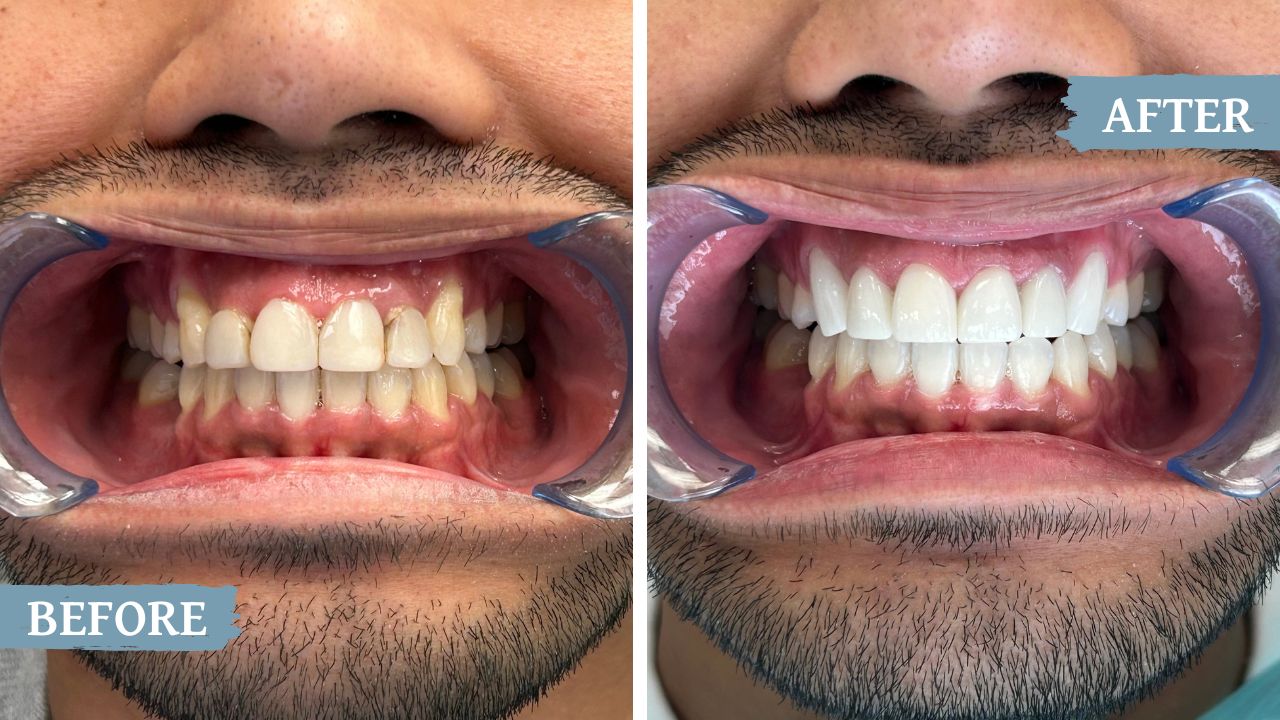 teeth before and after treatment