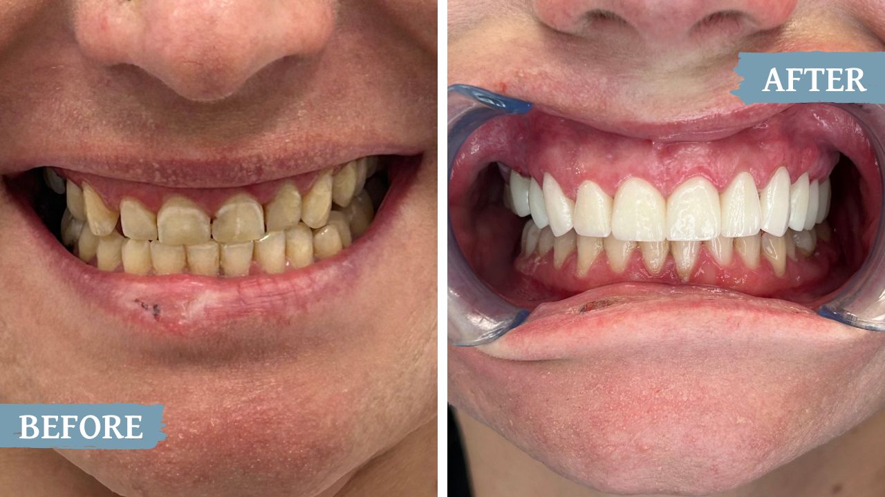 teeth before and after treatment